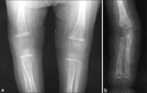 a) X-ray of the lower limb (AP view) showing proximal tibial metaphyseal erosions along with periosteal reaction and (b) X-ray of the upper limb (AP view) showing distal tibial and fibular metaphyseal erosions with periosteal reaction