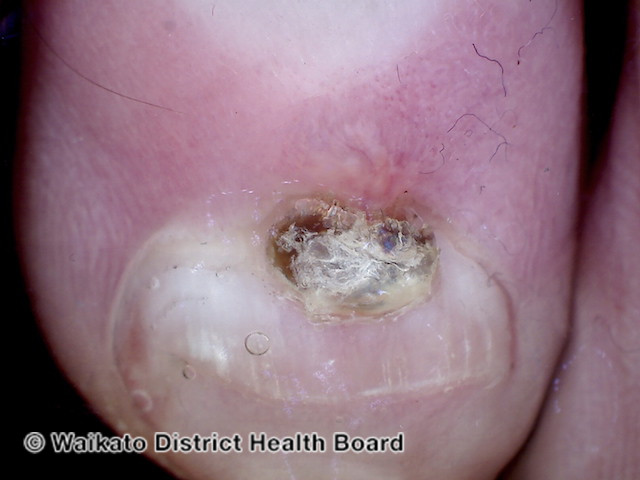 File:Digital myxoid cyst, toenail (DermNet NZ digital-myxoid-cyst-1-v2).jpg