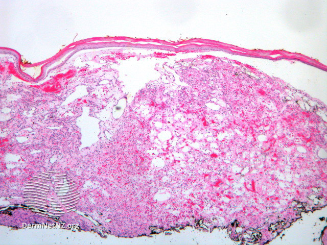 File:Figure 1 (DermNet NZ pathology-e-bacillary-angiomatosis-figure-1).jpg