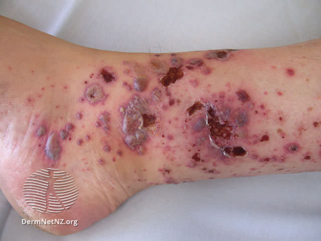 File:Hypersensitivity vasculitis (DermNet NZ doctors-systemic-images-vasc-hs3).jpg