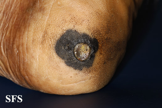 File:Melanoma (Dermatology Atlas 36).jpg