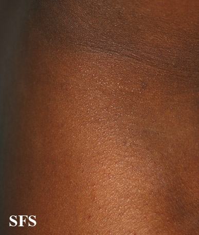 File:Miliaria (Dermatology Atlas 15).jpg