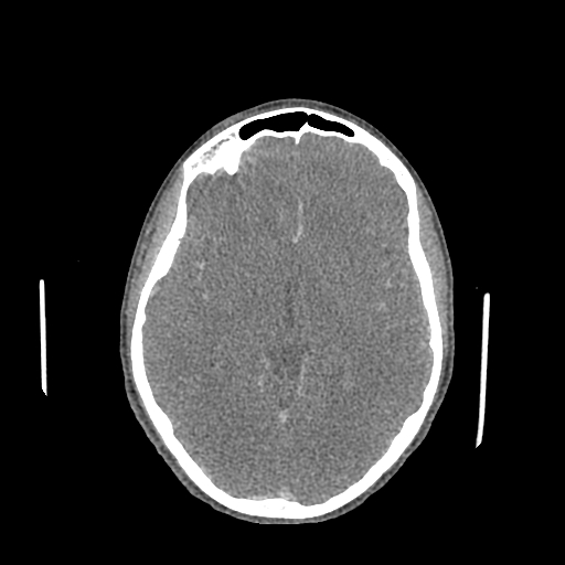 Nasal pyogenic granuloma (lobular capillary hemangioma) (Radiopaedia 85536-101244 C 108).jpg