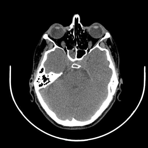 Nasopharyngeal carcinoma - infiltrating the clivus (Radiopaedia 62583-70875 Axial non-contrast 5).jpg