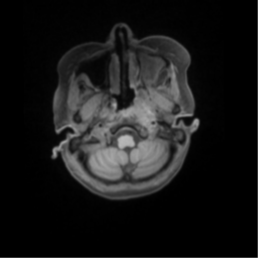 File:Nasopharyngeal carcinoma with cerebral abscess (Radiopaedia 43018-46274 Axial T1 fat sat 10).png