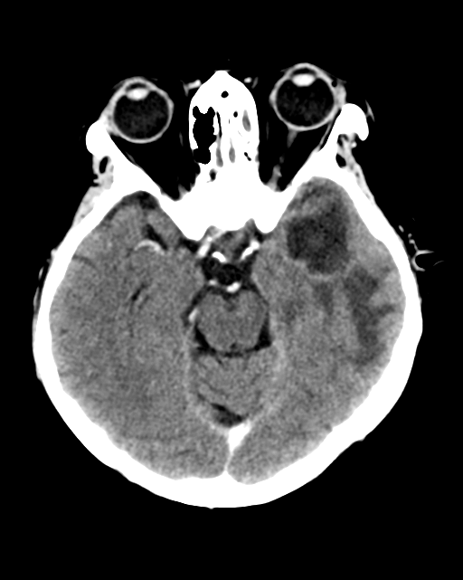 Nasopharyngeal carcinoma with cerebral abscess (Radiopaedia 43018-46275 Axial C+ delayed 20).png