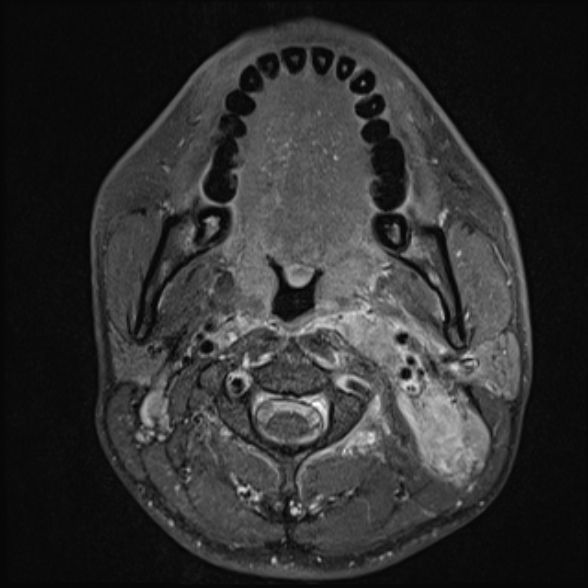 Nasopharyngeal carcinoma with skull base invasion (Radiopaedia 53415-59485 Axial T1 C+ fat sat 39).jpg