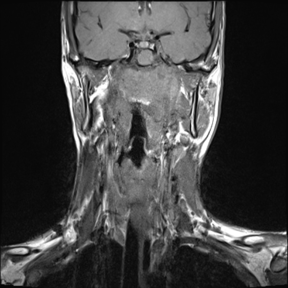File:Nasopharyngeal carcinoma with skull base invasion (Radiopaedia 53415-59485 Coronal T1 19).jpg