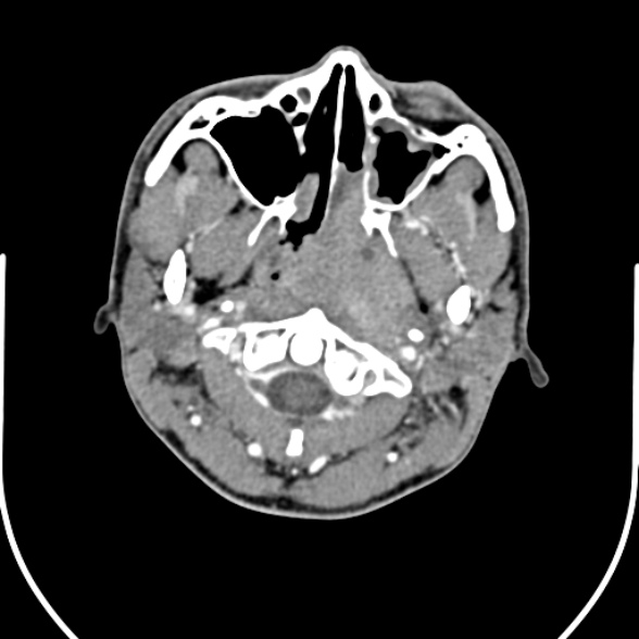 Nasopharyngeal carcinoma with skull base invasion (Radiopaedia 53415-59705 A 49).jpg