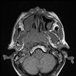 File:Nasopharyngeal carcinoma with skull base invasion (Radiopaedia 59258-66600 B 20).jpg
