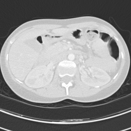 Necrobiotic pulmonary nodules - Crohn disease (Radiopaedia 20723-20631 Axial lung window 156).jpg