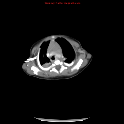 File:Neonatal neuroblastoma (Radiopaedia 9564-10223 A 4).jpg