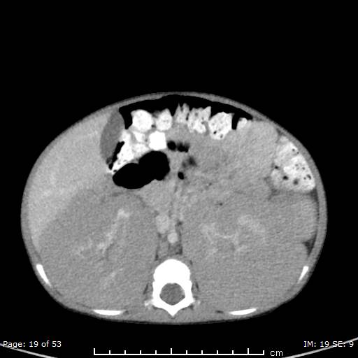 File:Nephroblastomatosis (Radiopaedia 41934-44935 A 19).jpg