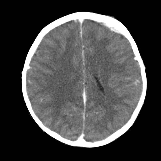 File:Neuroblastoma (Radiopaedia 8176-36438 B 3).jpg