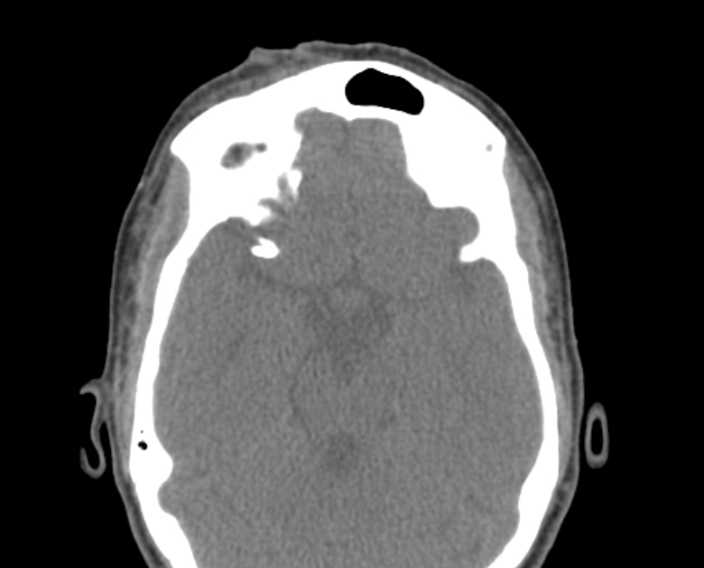Neurofibromatosis type 1- orbital manifestations (Radiopaedia 49391-54511 Axial non-contrast 62).jpg