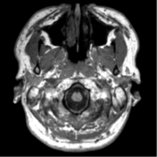 File:Neurofibromatosis type 2 (Radiopaedia 44936-48838 Axial T1 1).png