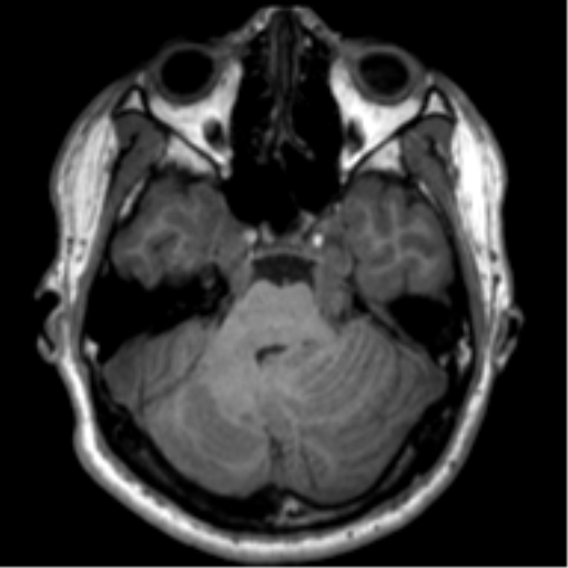 File:Neurofibromatosis type 2 (Radiopaedia 44936-48838 Axial T1 35).png
