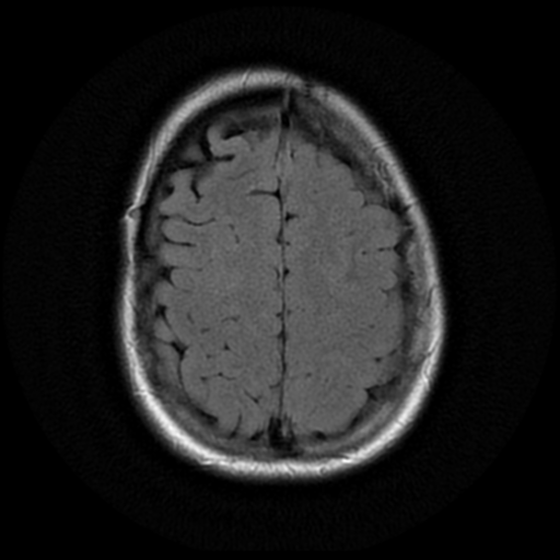 File:Neurofibromatosis type 2 (Radiopaedia 45229-49244 Axial FLAIR 17).png