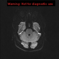 File:Neuroglial cyst (Radiopaedia 10713-11184 Axial DWI 39).jpg