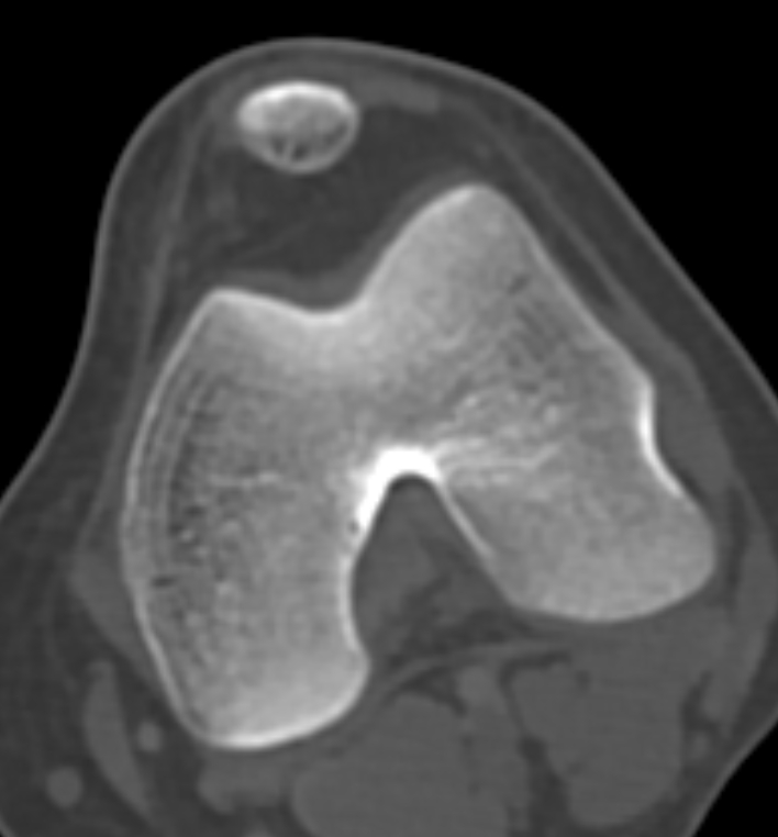 Non-ossifying fibroma - femur (Radiopaedia 82786-97042 Axial bone window 56).jpg