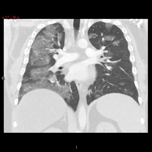 File:Non-specific interstitial pneumonitis (Radiopaedia 27044-27222 Coronal lung window 30).jpg