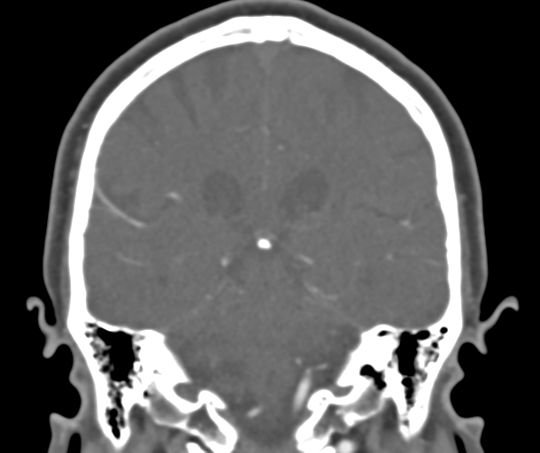 File:Normal CTA head (Radiopaedia 40801-43464 B 62).png