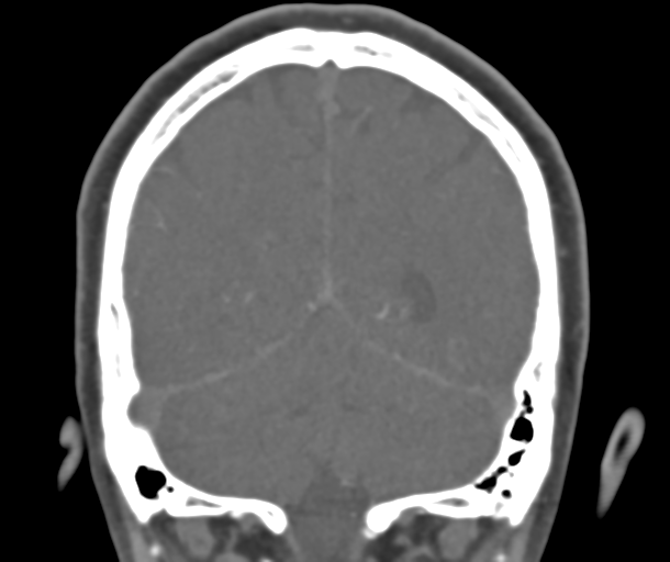 File:Normal CTA head (Radiopaedia 40801-43464 B 72).png