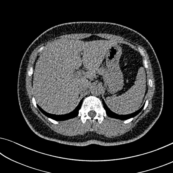 Normal CT chest- adult female (Radiopaedia 52522-58428 Axial non-contrast 125).jpg