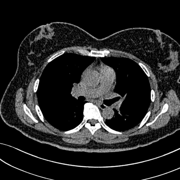 Normal CT chest- adult female (Radiopaedia 52522-58428 Axial non-contrast 61).jpg