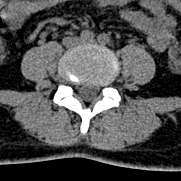 Normal CT lumbar spine (Radiopaedia 53981-60118 Axial non-contrast 71).jpg