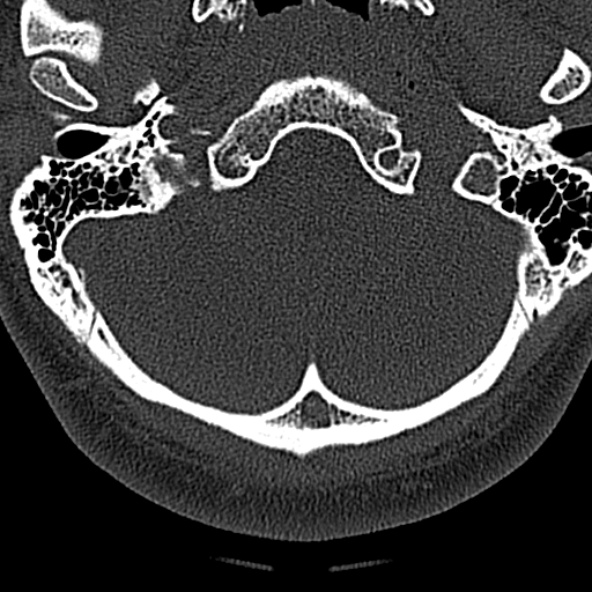 File:Normal CT of the cervical spine (Radiopaedia 53322-59305 Axial bone window 23).jpg