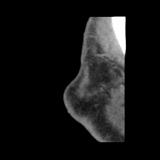 Normal CT paranasal sinuses (Radiopaedia 42286-45390 F 12).jpg