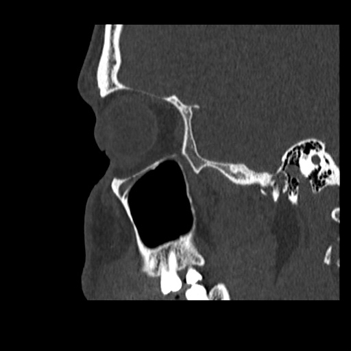Normal CT paranasal sinuses (Radiopaedia 42286-45390 Sagittal bone window 21).jpg