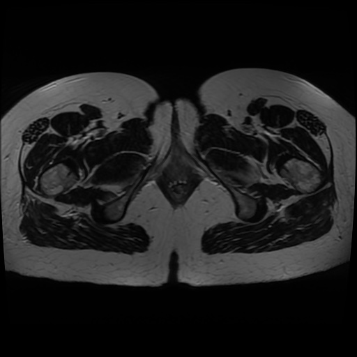Normal MRI abdomen in pregnancy (Radiopaedia 88005-104548 Axial T2 51).jpg