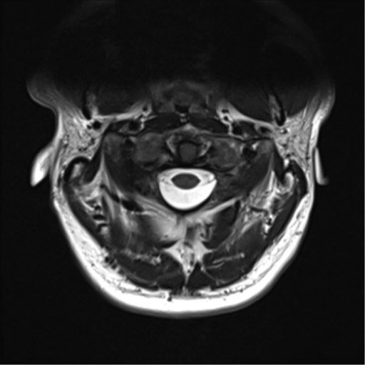 File:Normal MRI cervical spine (infection protocol) (Radiopaedia 53916-60039 Axial T2 10).png