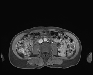 Normal adrenal glands MRI (Radiopaedia 82017-96004 M 62).jpg