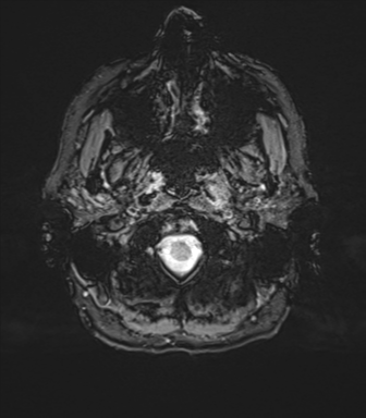 Normal brain MRI (TLE protocol) (Radiopaedia 40748-43405 Axial SWI 4).png