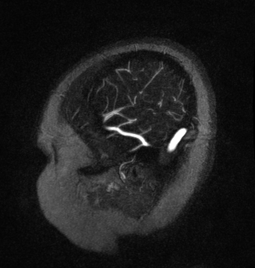 Normal brain MRI and venogram (Radiopaedia 39554-41862 Sagittal MRV 62).jpg