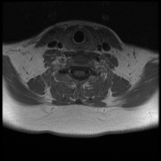 File:Normal cervical and thoracic spine MRI (Radiopaedia 35630-37156 Axial T1 C+ 12).png