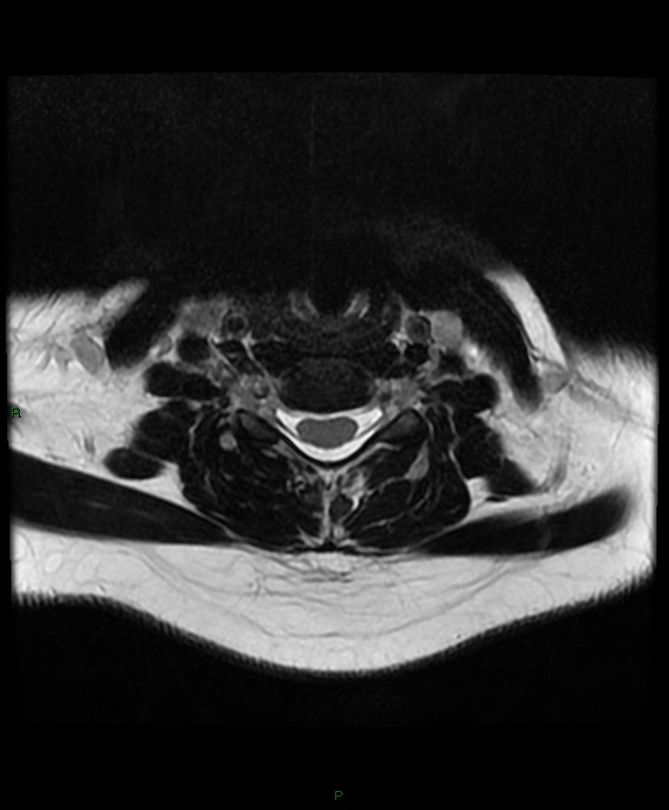 Normal cervical spine MRI (Radiopaedia 80146-93454 Axial T2 58).jpg