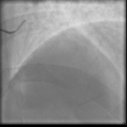 Normal coronary angiogram (DSA) (Radiopaedia 63081-71571 E 11).jpg