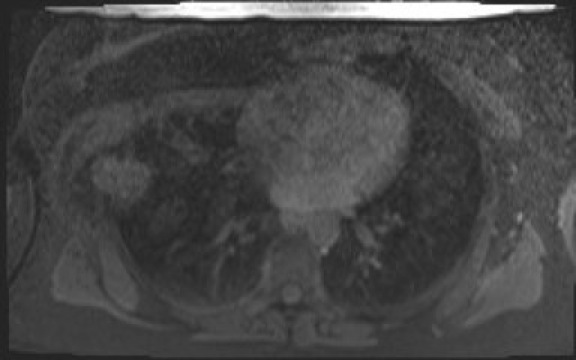 File:Normal hepatobiliary phase liver MRI (Radiopaedia 58968-66230 A 2).jpg
