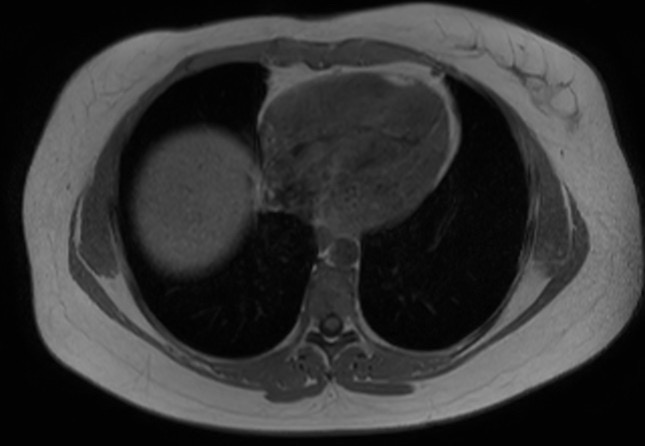 File:Normal liver MRI with Gadolinium (Radiopaedia 58913-66163 Axial T1 in-phase 31).jpg