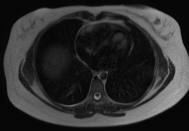 File:Normal liver MRI with Gadolinium (Radiopaedia 58913-66163 Axial T2 33).jpg