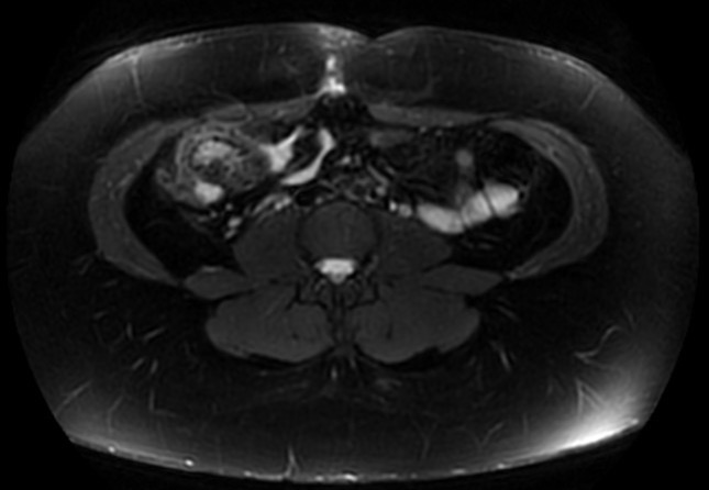 File:Normal liver MRI with Gadolinium (Radiopaedia 58913-66163 Axial T2 fat sat 4).jpg