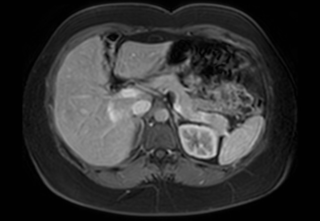 Normal liver MRI with Gadolinium (Radiopaedia 58913-66163 J 43).jpg