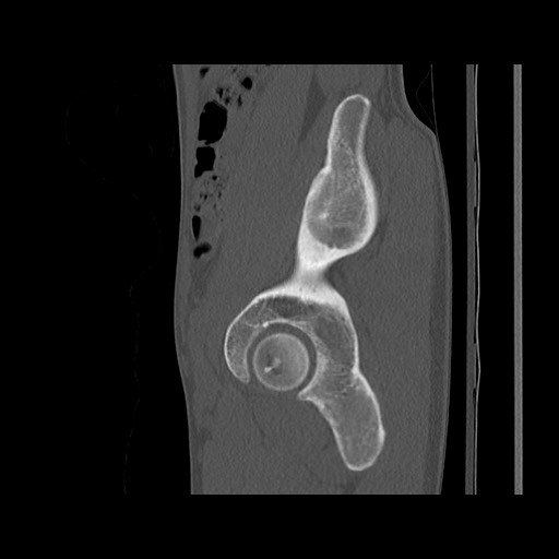 Normal pelvis (Radiopaedia 51473-57238 Sagittal bone window 43).jpg