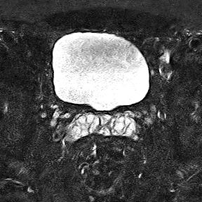 File:Normal prostate (MRI) (Radiopaedia 29986-30535 Axial STIR 17).jpg