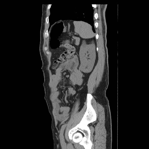 File:Obstructed kidney with perinephric urinoma (Radiopaedia 26889-27066 B 51).jpg