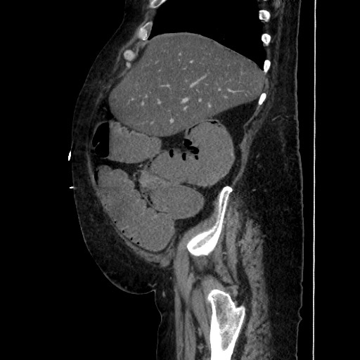 Obstructive colonic diverticular stricture (Radiopaedia 81085-94675 C 64).jpg
